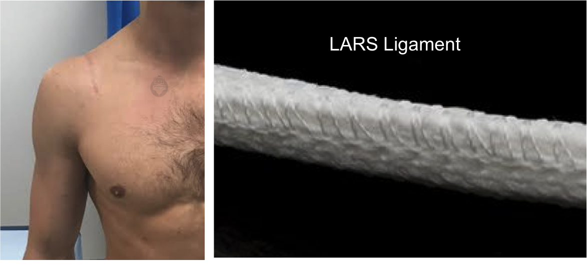 Acromioclavicular Joint Repair and Reconstruction